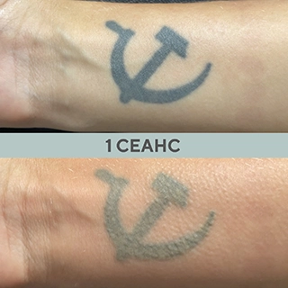 Фото до и после сведение татуировок